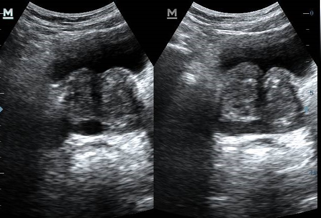 Seminal Vesicle Cyst 