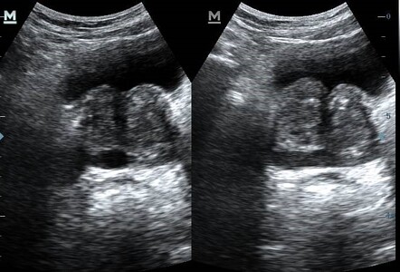 Seminal vesicle cyst | Image | Radiopaedia.org