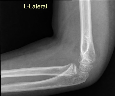 Supracondylar Fracture | Radiology Case | Radiopaedia.org