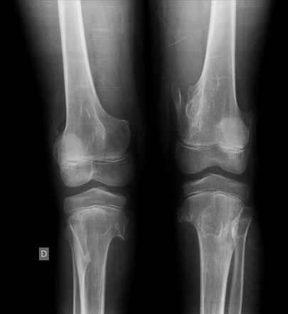 Hereditary multiple exostoses (osteochondromatosis) | Radiology Case ...