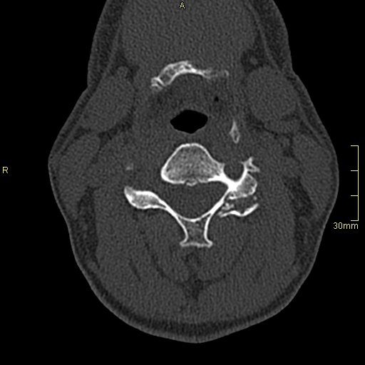 Unilateral facet joint fracture dislocation | Image | Radiopaedia.org