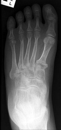 Osteogenesis imperfecta with a fracture | Radiology Case | Radiopaedia.org