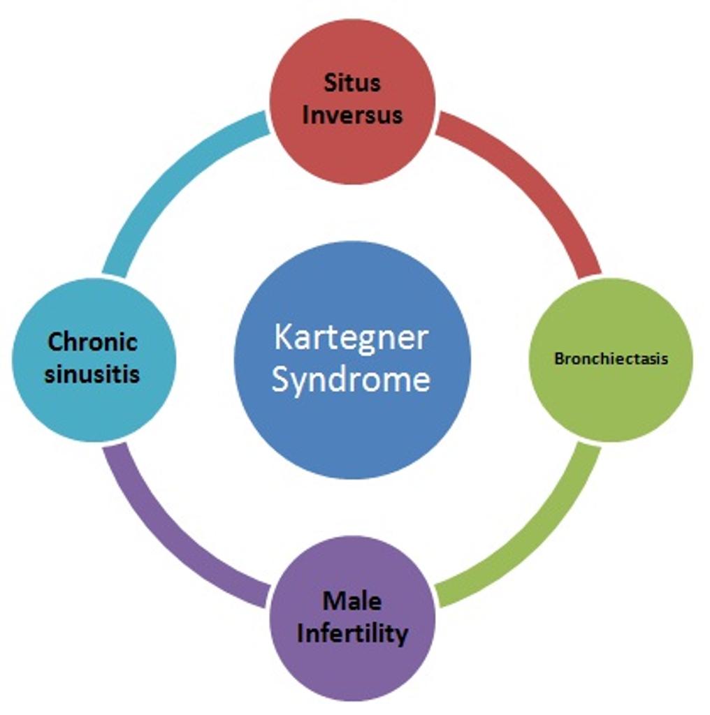 kartagener syndrome triad Kartagener Syndrome Multisystem Findings Radiology Case Radiopaedia Org kartagener syndrome triad