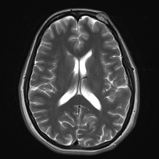 Calvarial hemangioma | Image | Radiopaedia.org