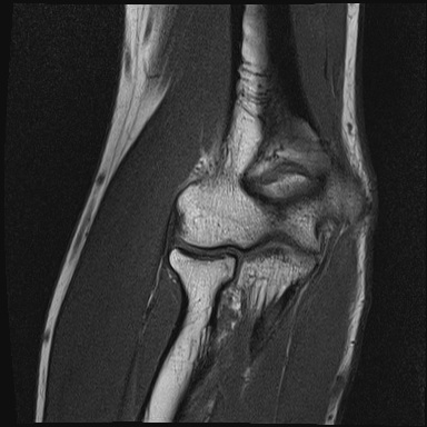 Normal MRI right elbow | Image | Radiopaedia.org