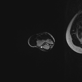 Normal MRI right elbow | Image | Radiopaedia.org