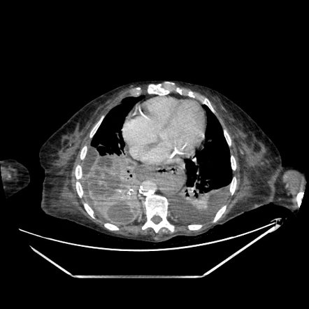 Lung abscess and pleural empyema | Radiology Case | Radiopaedia.org