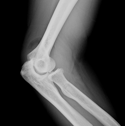 Radial Head And Coronoid Process Fractures | Radiology Case ...