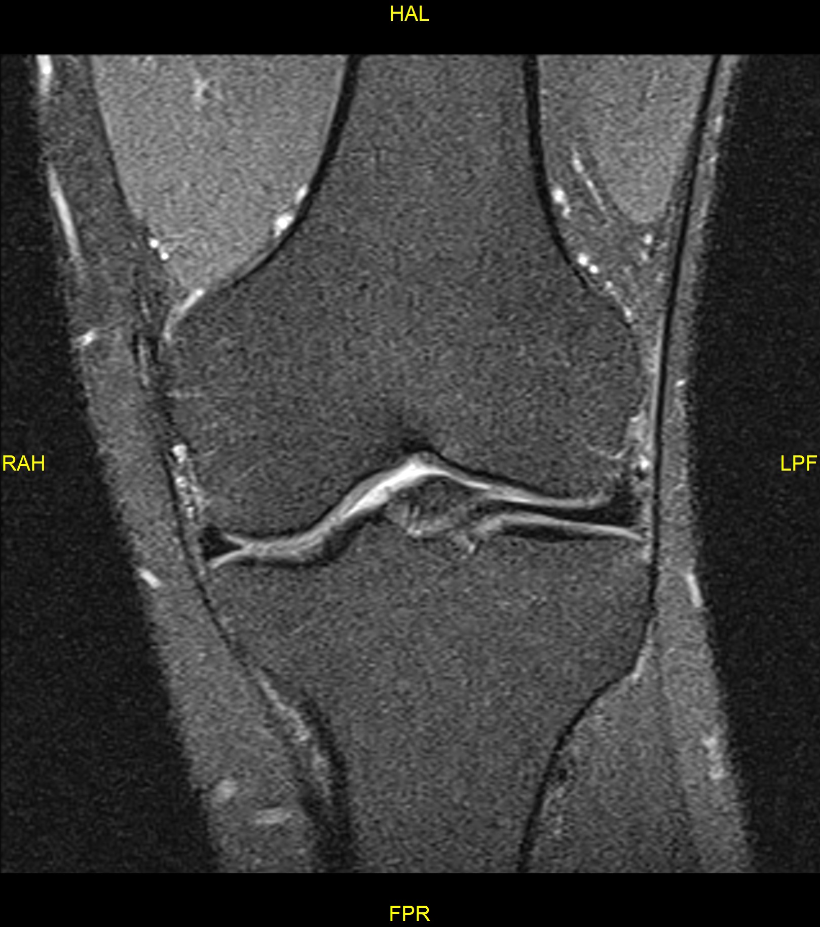 Hoffa's fat pad tenosynovial giant cell tumor | Image | Radiopaedia.org