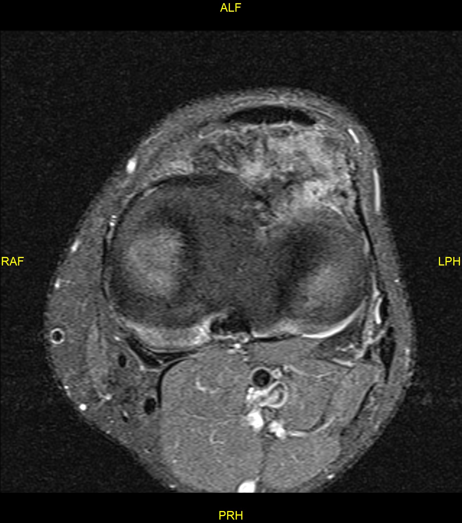 Hoffa's fat pad tenosynovial giant cell tumor | Image | Radiopaedia.org