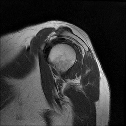 Avulsion Fracture Greater Tuberosity Of Humerus Image Radiopaedia Org