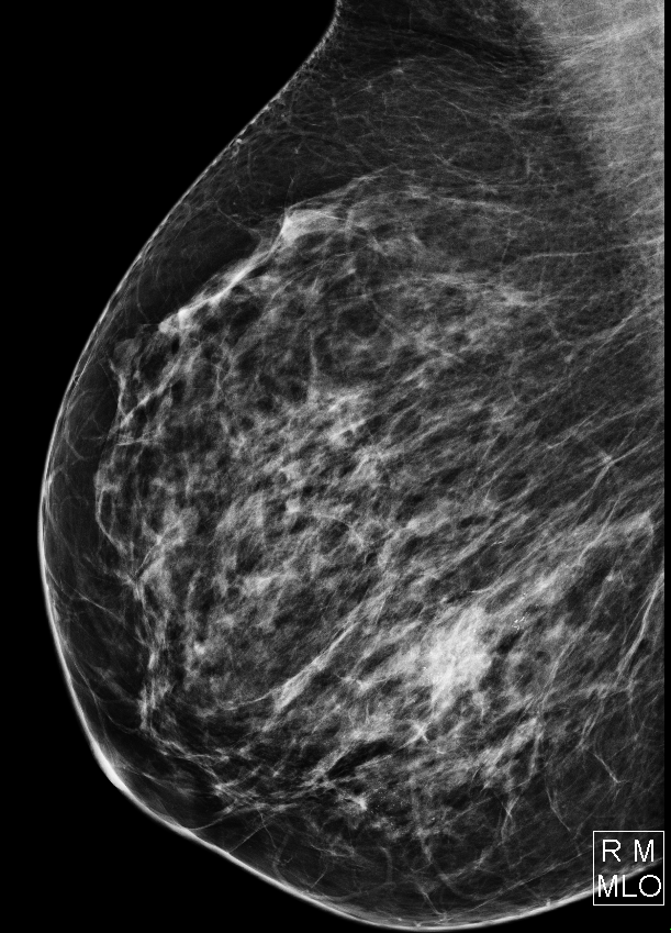 Breast Mass Bi Rads 5 Image