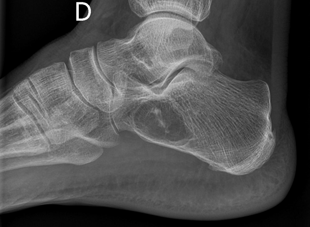 Intraosseous lipoma | Radiology Reference Article | Radiopaedia.org