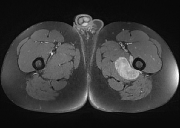 Thigh synovial sarcoma | Image | Radiopaedia.org