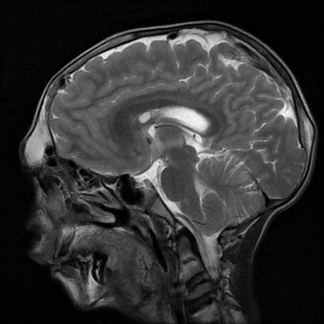 Proteus syndrome | Image | Radiopaedia.org