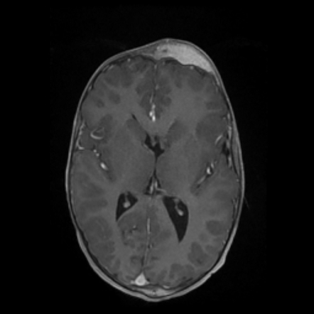 Proteus syndrome | Image | Radiopaedia.org