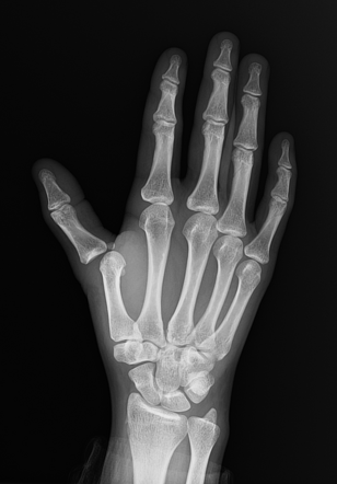 First metacarpophalangeal joint dislocation | Image | Radiopaedia.org