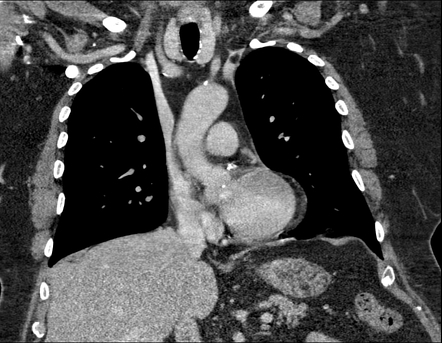 Intravascular lipoma of the brachiocephalic vein | Radiology Case ...