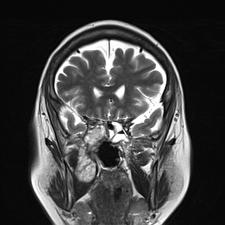 Nasopharyngeal chordoma | Radiology Case | Radiopaedia.org