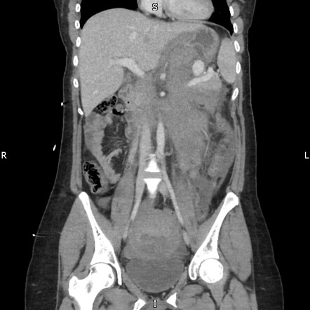 Splenic artery aneurysm | Radiology Reference Article | Radiopaedia.org