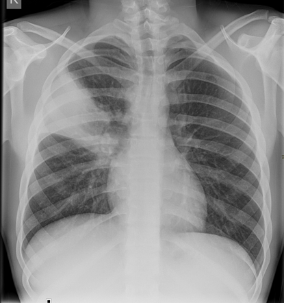 Right upper lobe pneumonia - with follow-up | Radiology Case ...