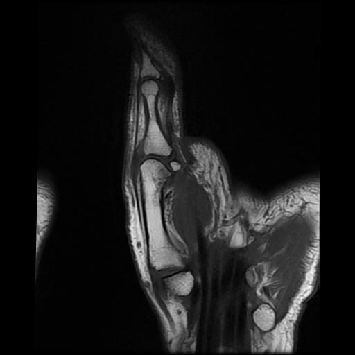 Radial collateral ligament avulsion injury - thumb | Image ...