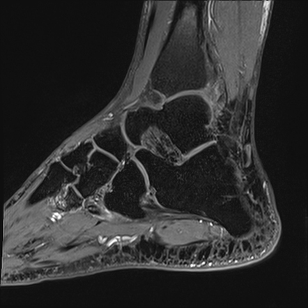 Painful Os Peroneum Syndrome Pops Image Radiopaedia Org