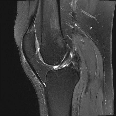 Medial gastrocnemius tendinopathy | Radiology Case | Radiopaedia.org