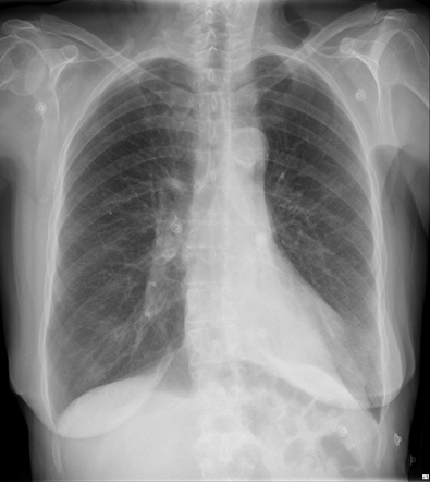 Left lower lobe collapse | Radiology Case | Radiopaedia.org