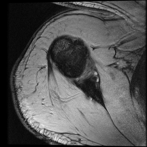 Glenoid Labral Tear With Paralabral Cyst Image