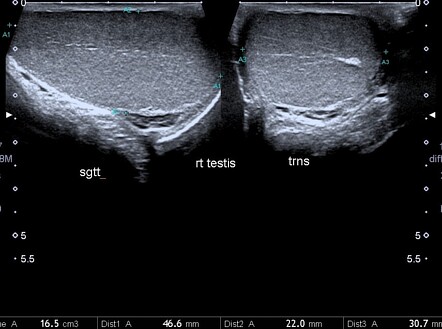 Atrophic testis | Image | Radiopaedia.org