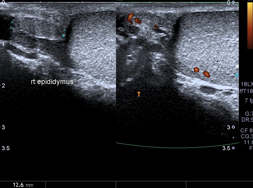 Atrophic testis | Image | Radiopaedia.org