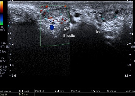 Atrophic testis | Radiology Case | Radiopaedia.org