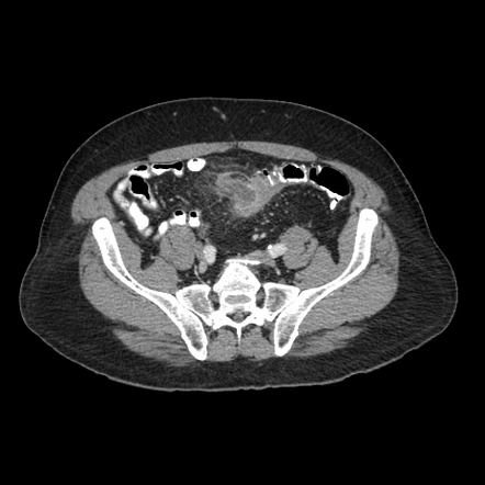 Acute sigmoid diverticulitis with abscess formation | Radiology Case ...