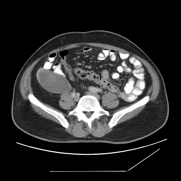 Low-grade appendiceal mucinous neoplasm | Radiology Reference Article ...