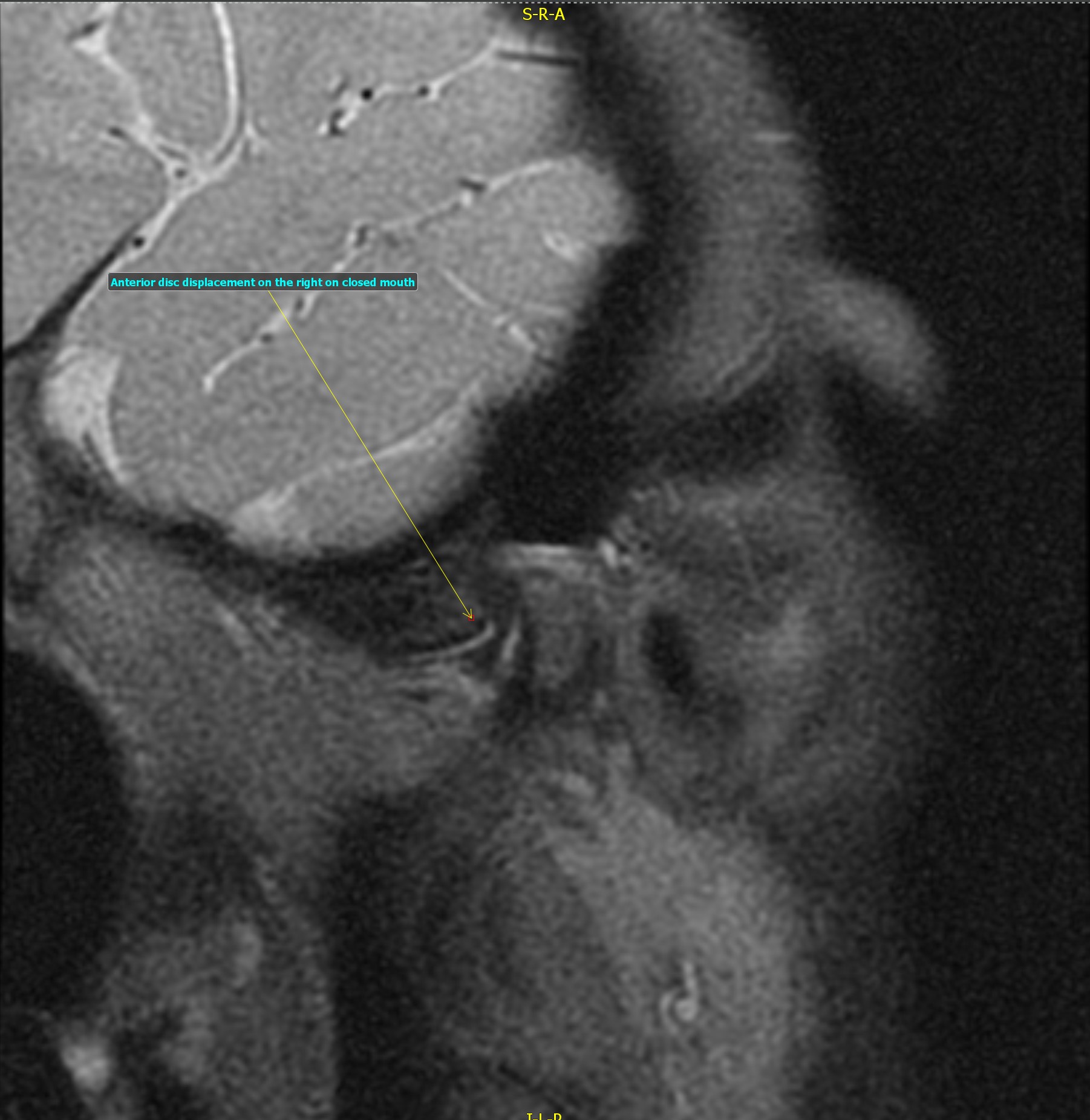 Temporomandibular joint with anterior disc dislocation and recapture ...