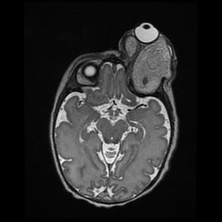 Orbital teratoma | Image | Radiopaedia.org