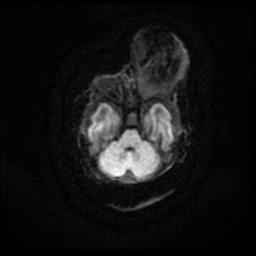 Orbital teratoma | Image | Radiopaedia.org