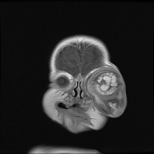 Orbital Teratoma Image