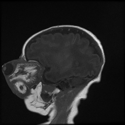 Orbital teratoma | Image | Radiopaedia.org