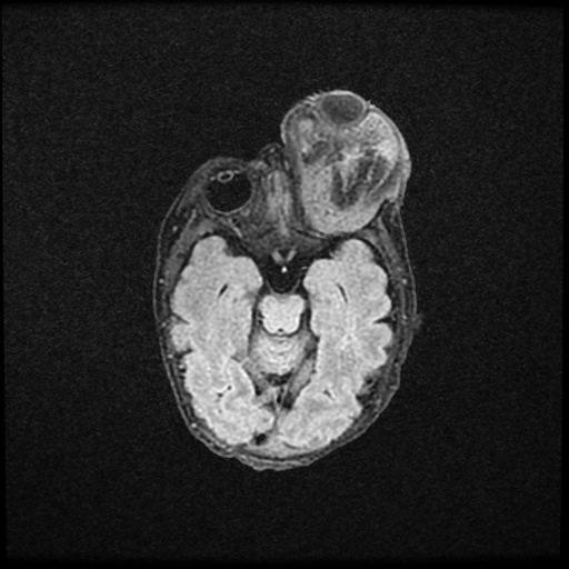 Orbital teratoma | Image | Radiopaedia.org