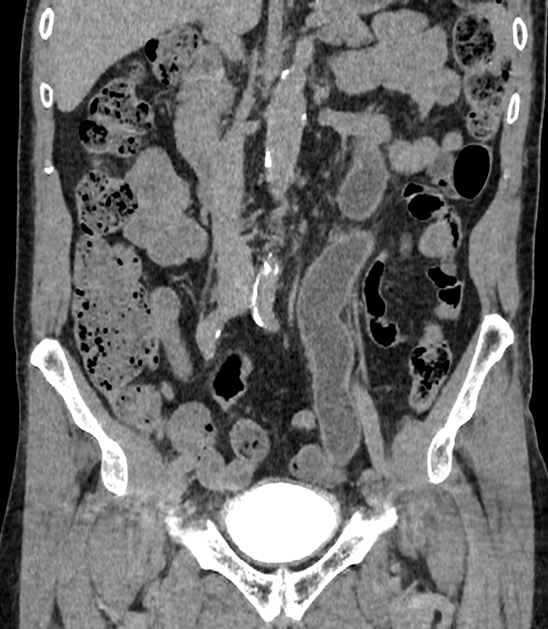 Duplex kidney with ectopic ureter | Image | Radiopaedia.org