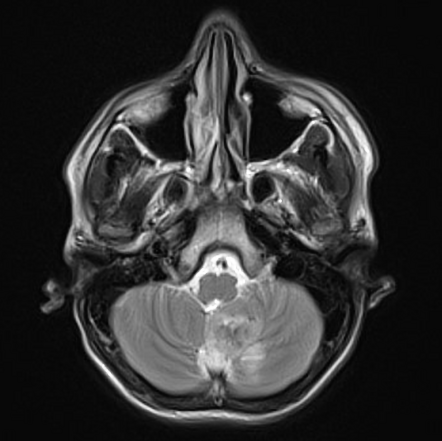 Calcifying pseudoneoplasm of neuraxis (CAPNON) | Image | Radiopaedia.org