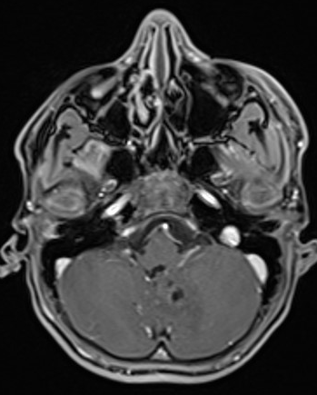 Calcifying pseudoneoplasm of neuraxis (CAPNON) | Image | Radiopaedia.org