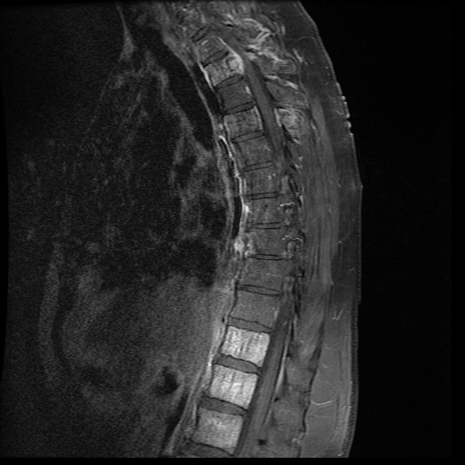 Aggressive Vertebral Hemangioma Image