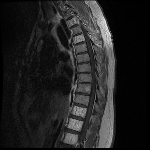 Aggressive Vertebral Hemangioma Image