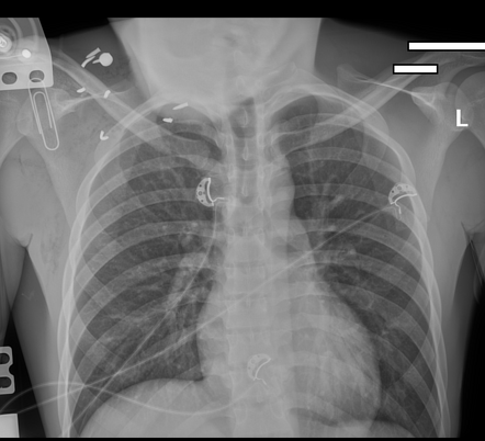 Radically invasive projectile injury - thorax | Radiology Case ...