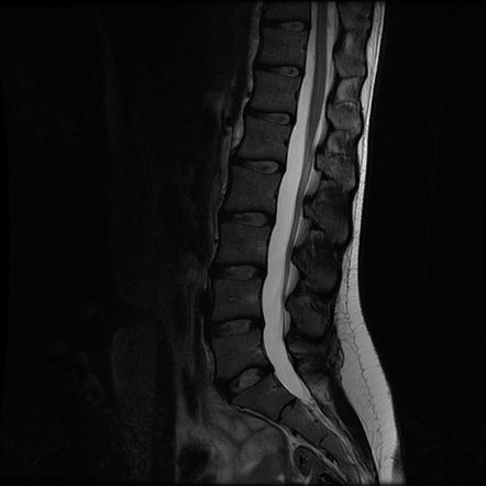 Normal lumbar spine MRI with AI denoise | Radiology Case | Radiopaedia.org