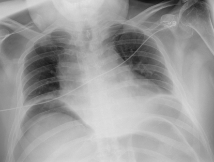 Tension pneumoperitoneum | Radiology Case | Radiopaedia.org