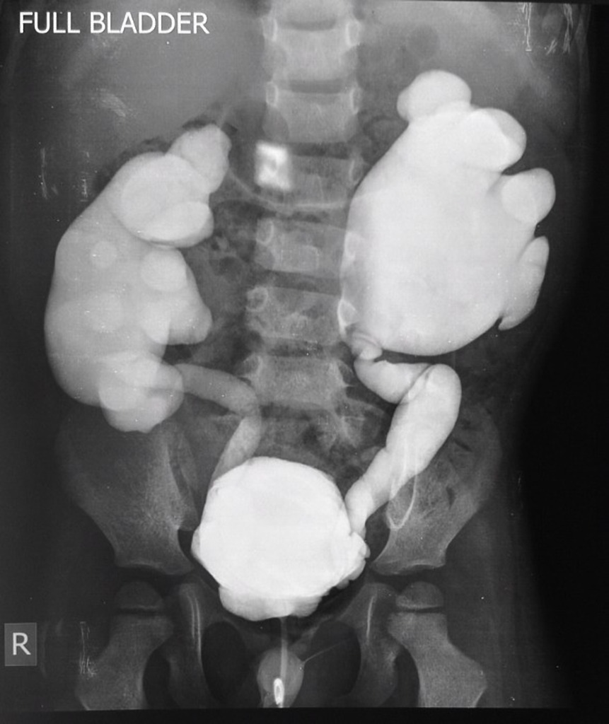 Vesicoureteric Reflux Grade V Radiology Case Radiopaedia Org